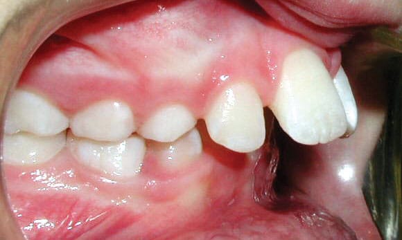 Upper Front Teeth Protrusion